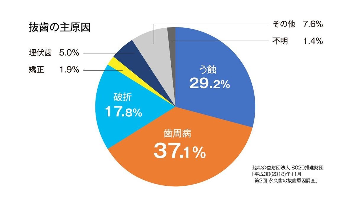 歯周病、抜歯、歯みがき